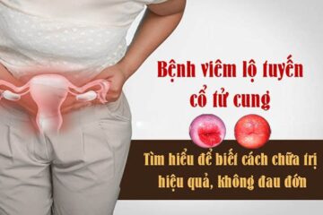 Nguyên nhân bị viêm lộ tuyến cổ tử cung – Biện pháp phòng bệnh