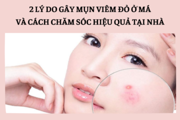 Mụn viêm đỏ ở má do đâu mà có? Cách thổi bay mụn viêm trong 1 nốt nhạc