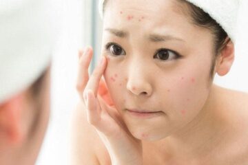 Top 2 biến chứng nguy hiểm nếu mụn viêm không được xử lý đúng cách