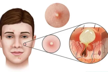 Mách bạn 3 lý do không nên tự nặn mụn viêm tại nhà